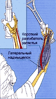 Локоть теннисиста